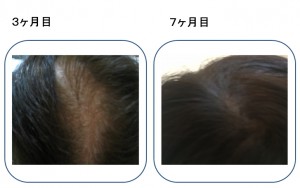 脱毛写真